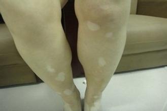 10岁小孩身上有白斑怎么办