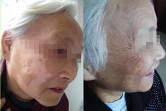 邢台医院用什么方法治疗白癜风有效