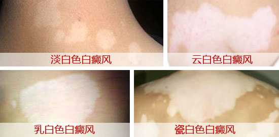 心理压力会导致白癜风病情严重吗