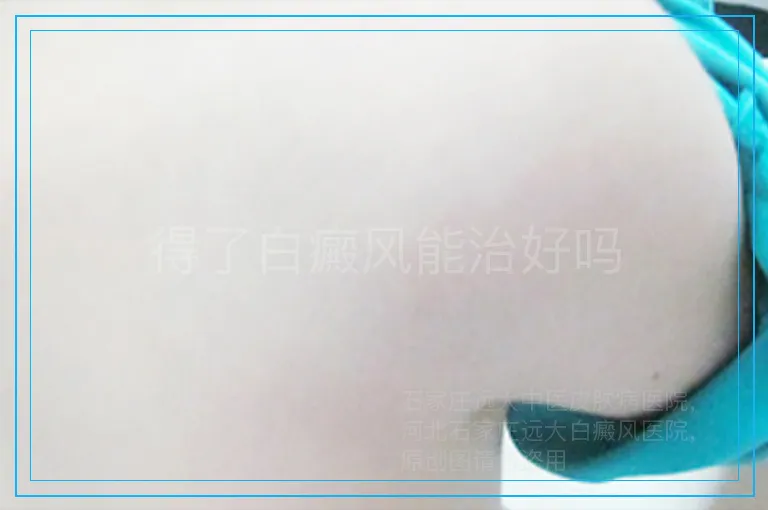 得了白癜风能治好吗