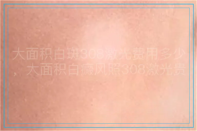 大面积白斑308激光费用多少，大面积白癜风照308激光贵不贵，白斑面积大用308激光花多少钱