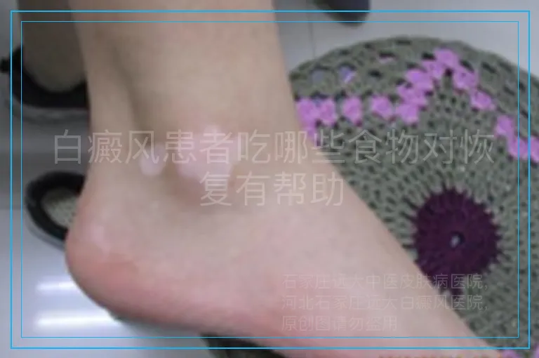 白癜风患者吃哪些食物对恢复有帮助