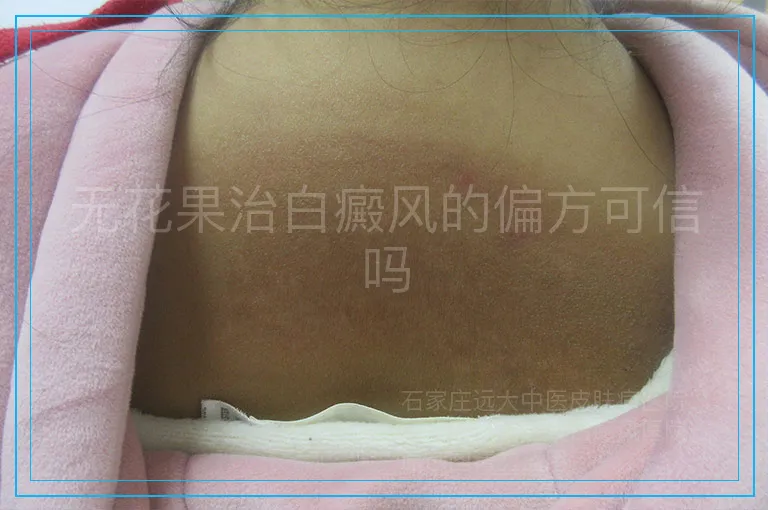 无花果治白癜风的偏方可信吗