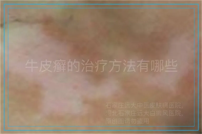 牛皮癣的治疗方法有哪些