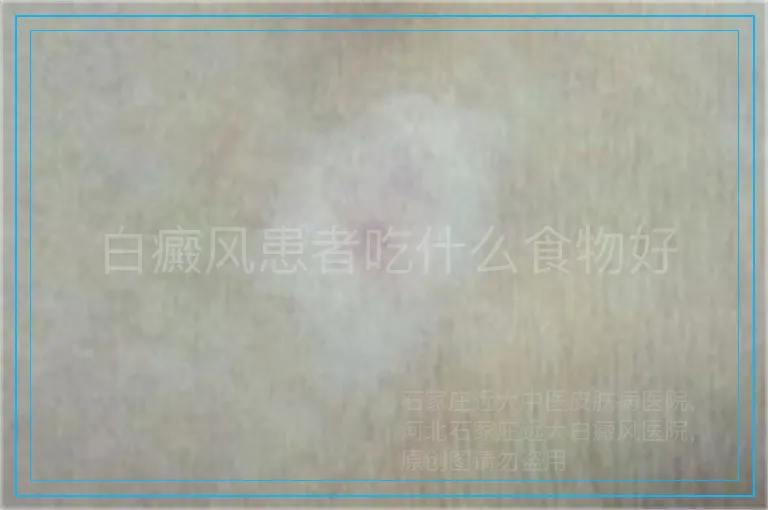 白癜风患者吃什么食物好
