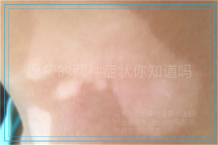 湿疹的两种症状你知道吗