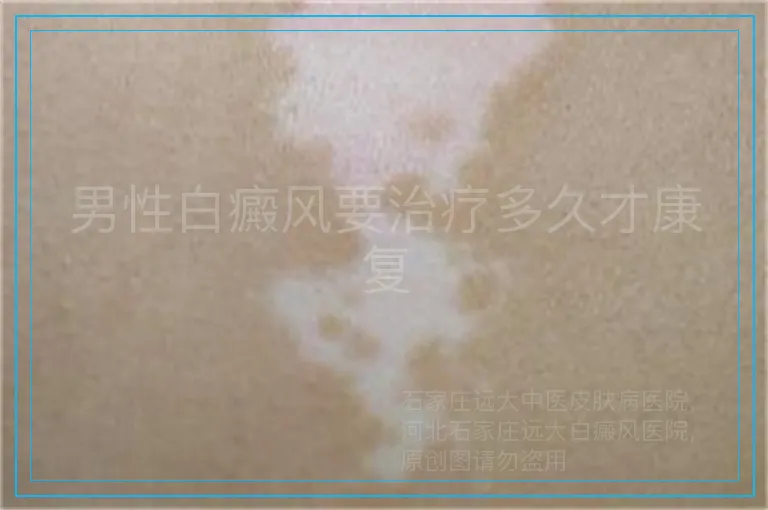 男性白癜风要治疗多久才康复