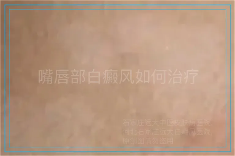 嘴唇部白癜风如何治疗