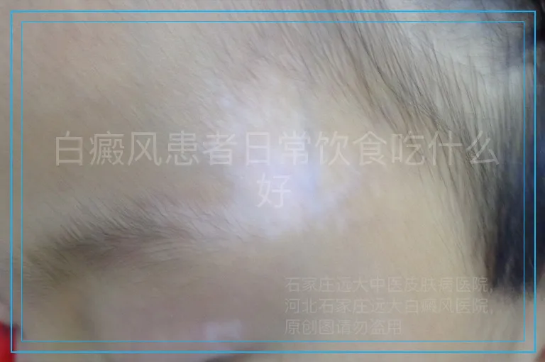 白癜风患者日常饮食吃什么好