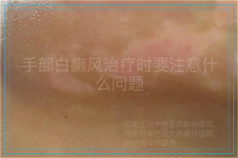 手部白癜风治疗时要注意什么问题
