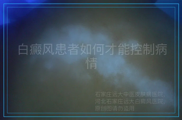 白癜风患者如何才能控制病情