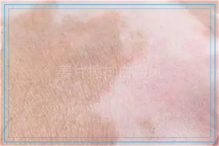 姜片擦拭白癜风