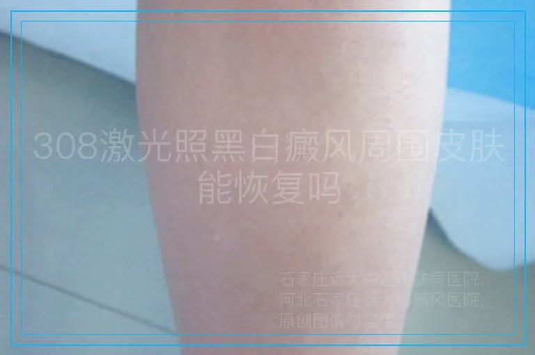 308激光照黑白癜风周围皮肤能恢复吗