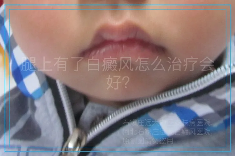 腿上有了白癜风怎么治疗会好？