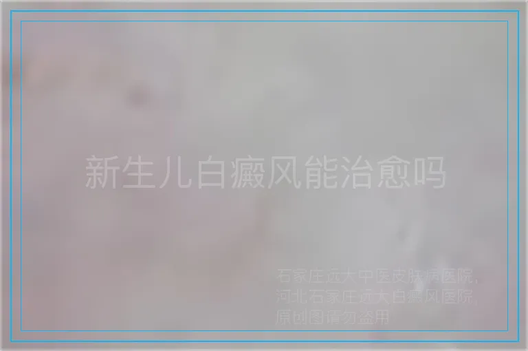 新生儿白癜风能治愈吗