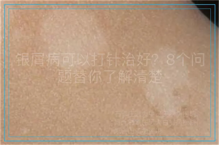 银屑病可以打针治好？8个问题替你了解清楚
