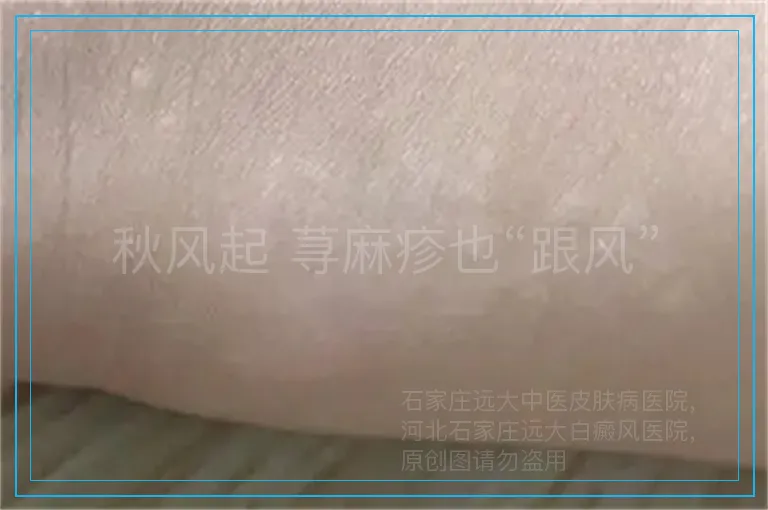 秋风起 荨麻疹也“跟风”