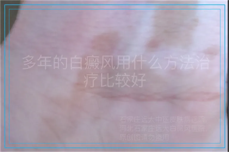 多年的白癜风用什么方法治疗比较好