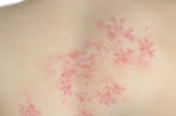 荨麻疹症状图